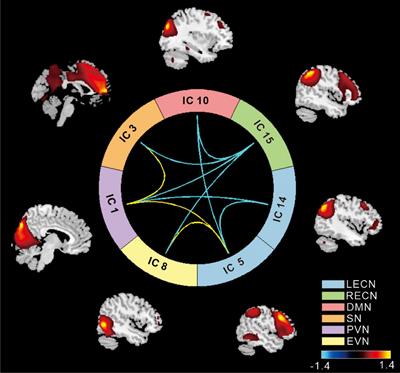 Altered Functional Network Connectivity of Precuneus and Executive Control Networks in Type 2 Diabetes Mellitus Without Cognitive Impairment